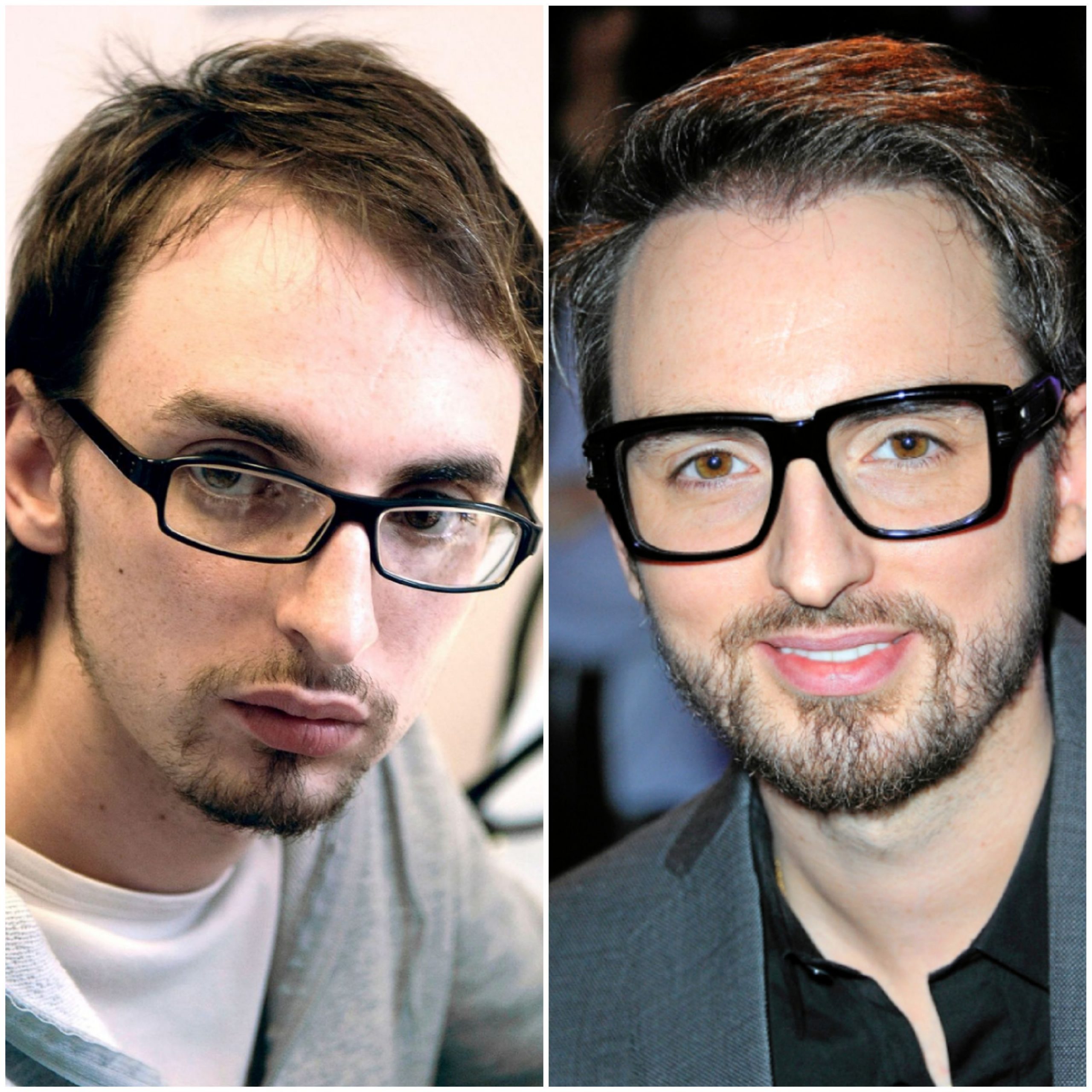 Christophe Willem greffe de cheveux