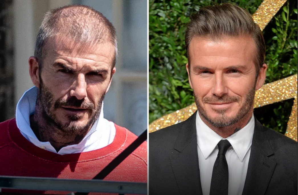 David Beckham greffe de cheveux