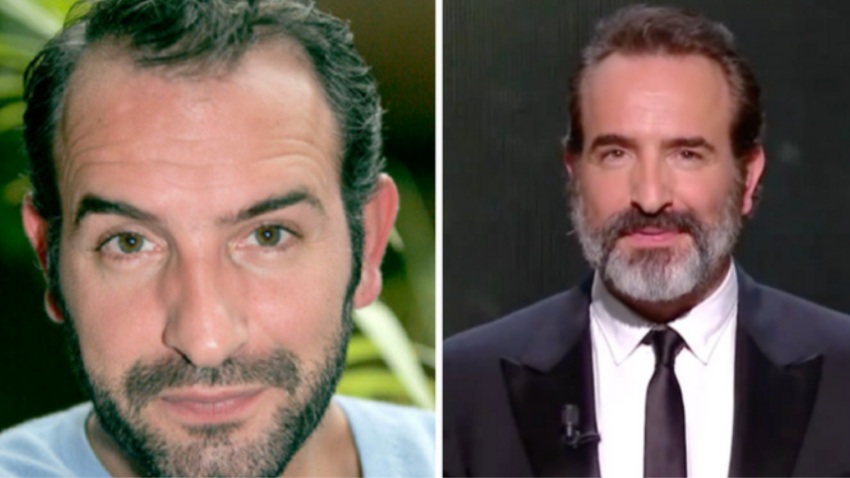 Jean Dujardin greffe de cheveux