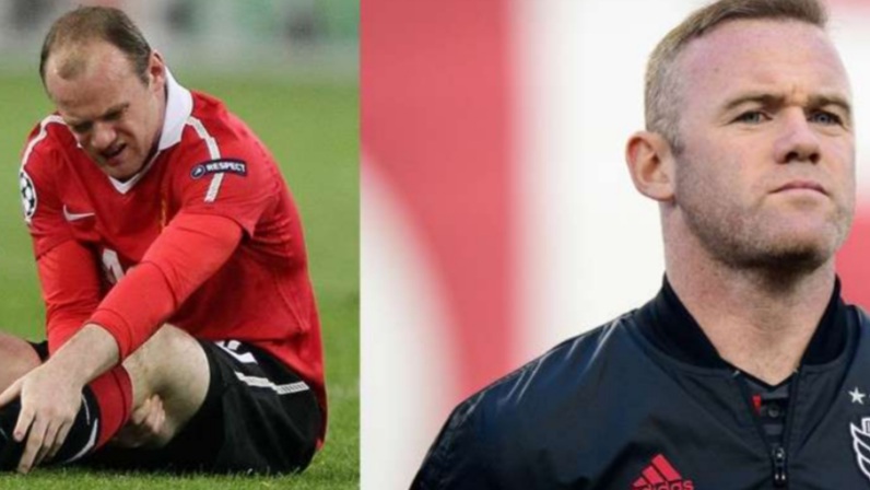 Wayne Rooney greffe de cheveux